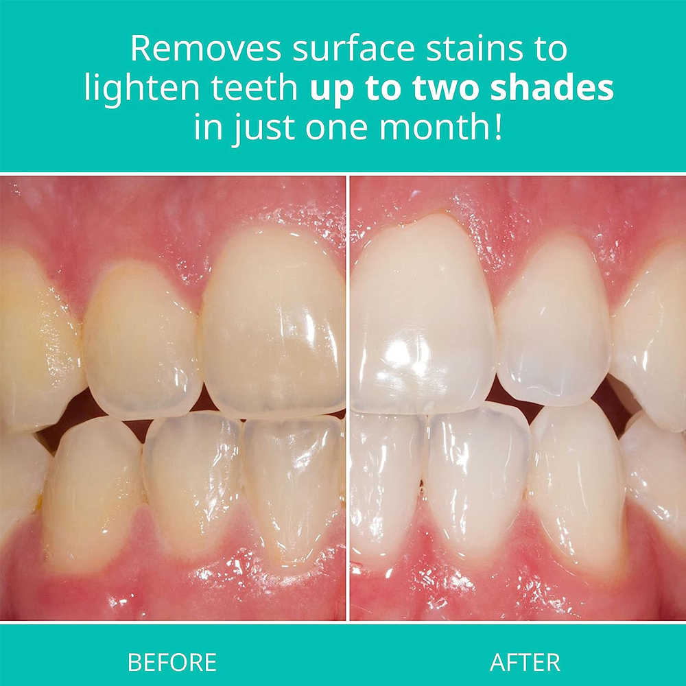 Opalescence Whitening Toothpas - đánh giá và giá Teeth Whitening Gel Opalescence
