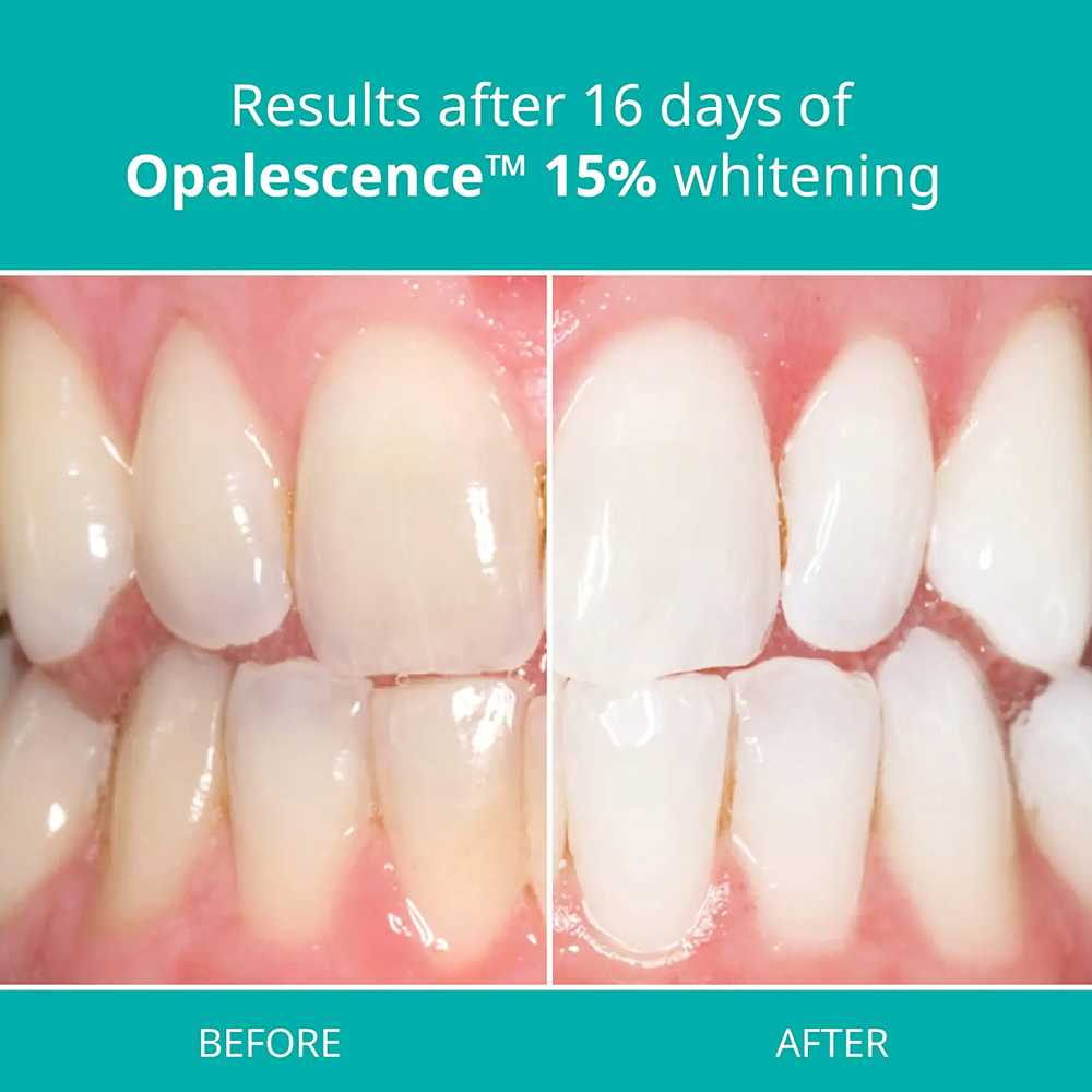 Opalescence Professional White - đánh giá và giá Teeth Whitening Gel Opalescence