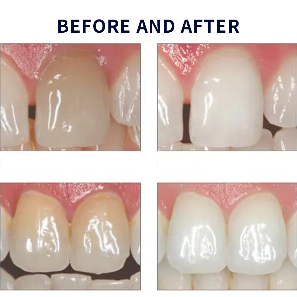 Opalescence Whitening 20% PF 2 - đánh giá và giá Teeth Whitening With Hydrogen Peroxide