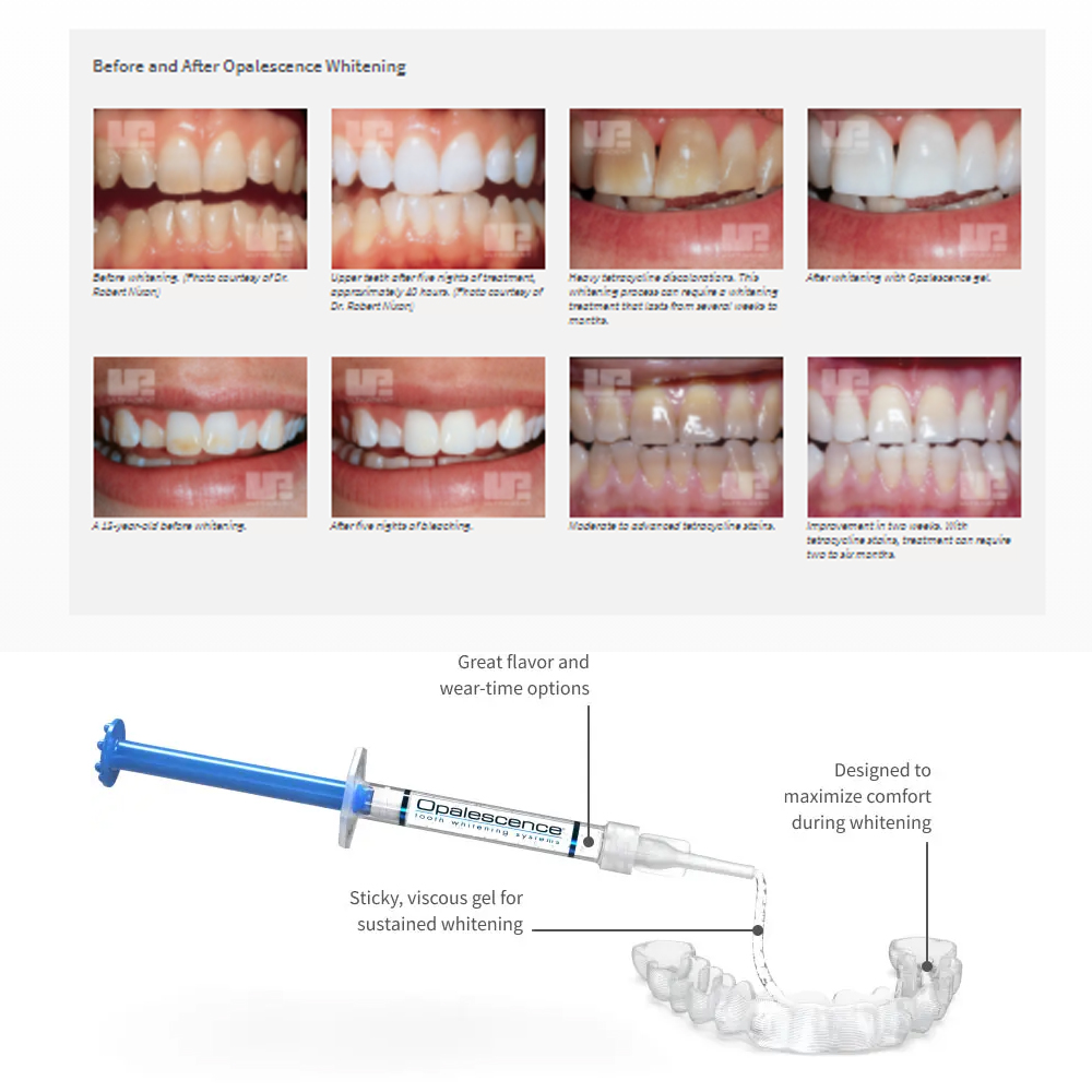 Opalescence Whitening 20% PF 2 - đánh giá và giá Teeth Whitening With Hydrogen Peroxide