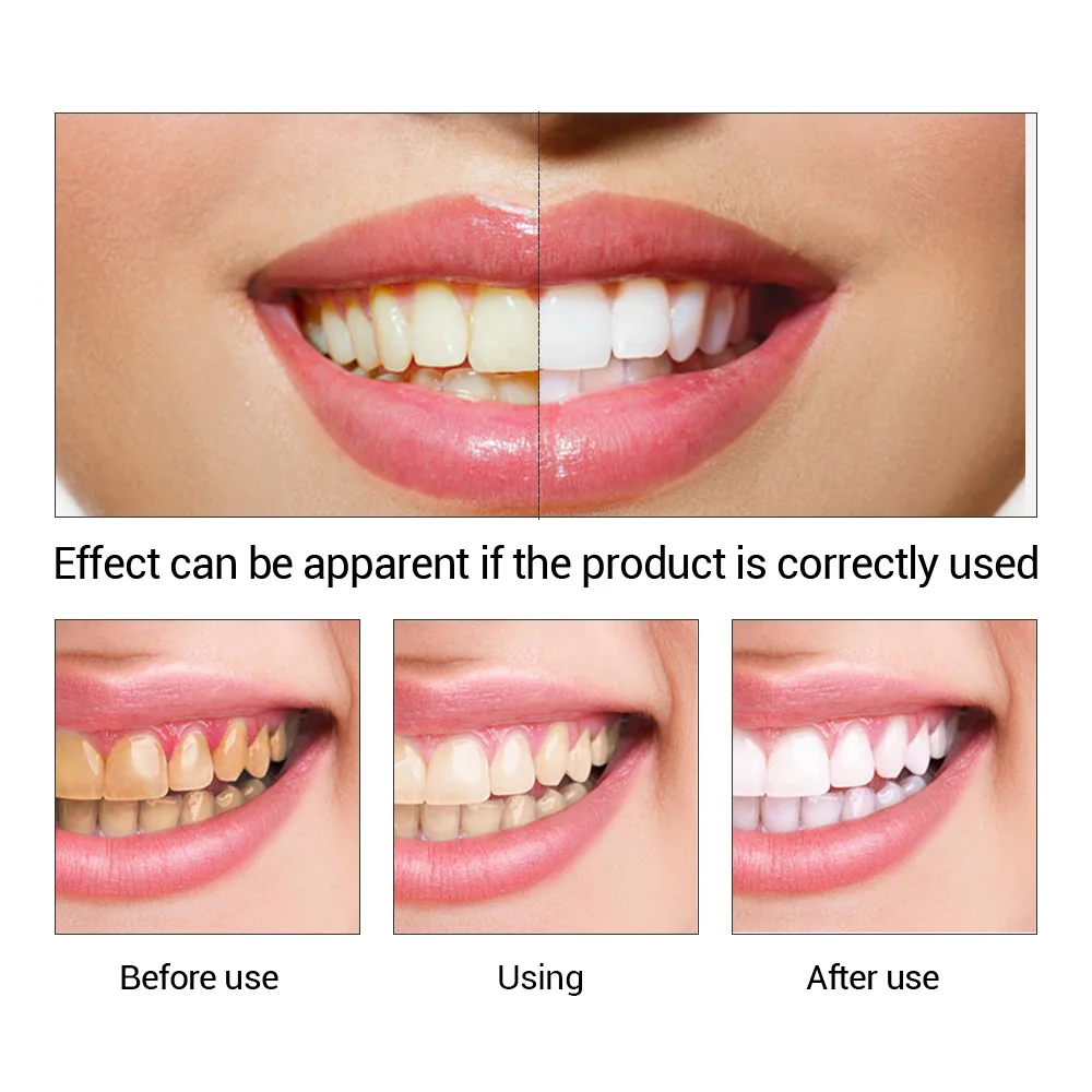 FTEENPLY Làm Trắng Răng Tinh C - đánh giá và giá Teeth Whitening From Home