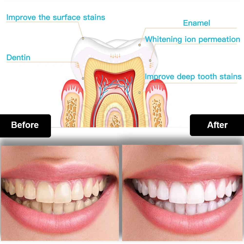 Dental Teeth Whitening Kit Min - đánh giá và giá Teeth Whitening Kit With Light