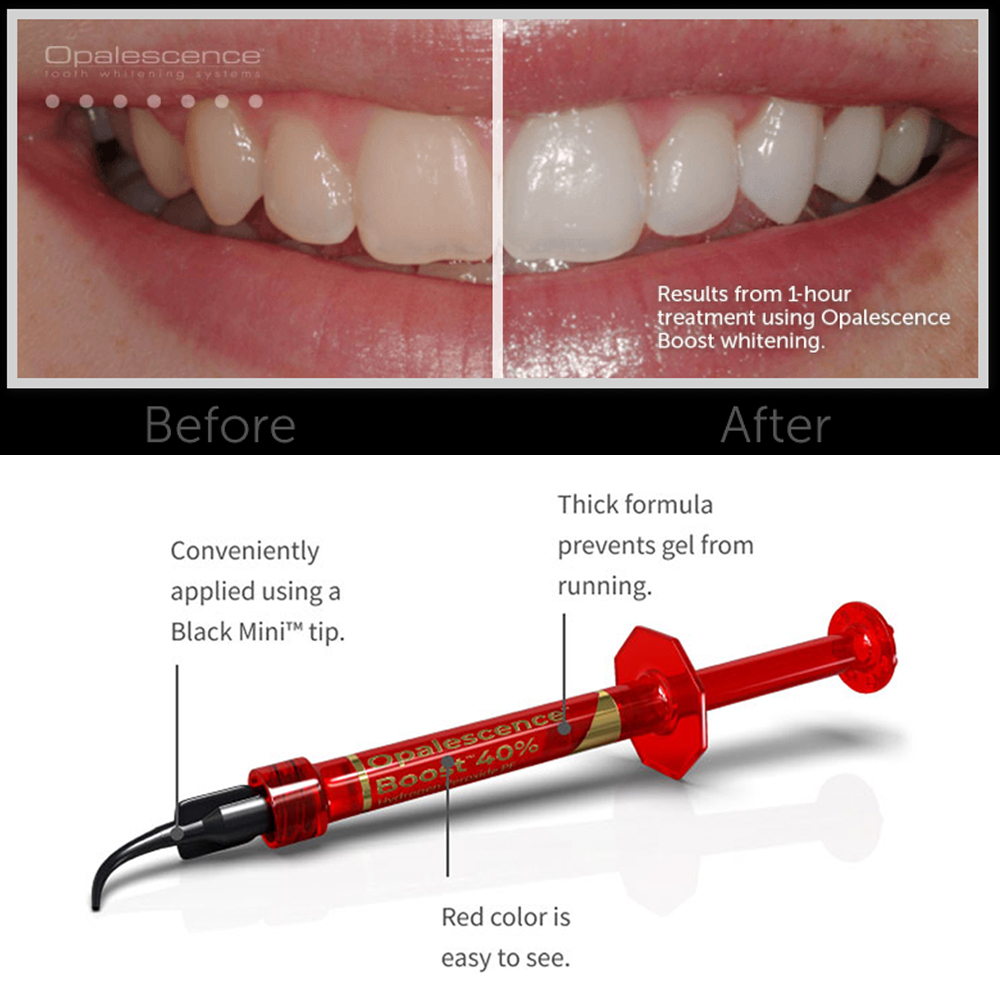 Ultradent Opalescence Boost PF - đánh giá và giá Teeth Whitening Gel Opalescence